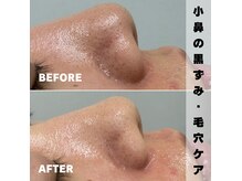 ベレア(BELEA)/小鼻の黒ずみ毛穴ケアに☆