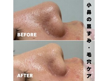 ベレア(BELEA)/小鼻の黒ずみ毛穴ケアに☆