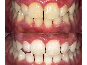 ライトケアサロン 表参道店(Light Care Salon)/セルフホワイトニング