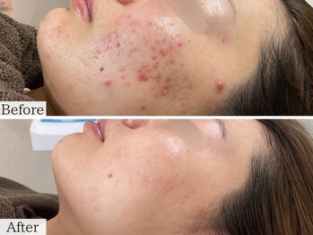 ニキビケア研究所 吉祥寺店