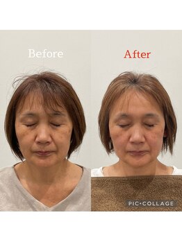 鍼灸チャンドラ(鍼灸Chandra)/美人鍼