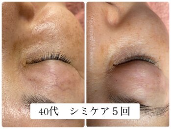 ヌー 栄(nuu)/シミケア5回　40代
