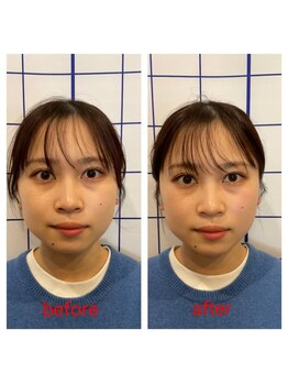 しろくま整体院 鷺ノ宮阿佐ヶ谷院/美容鍼♪