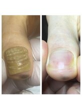 プラスキュア 用賀店(+CURE)/肥厚爪 変形爪 副爪 60分6600～