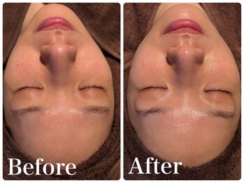 ボヌールデソワ(Bonheur de Soi)/ハーブピーリング