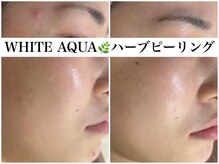 アワピール 天王寺店(AWA PEELL)/ハーブピーリング/ニキビケア