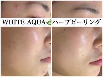 アワピール 天王寺店(AWA PEELL)/ハーブピーリング/ニキビケア