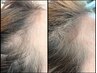 【最新プラズマ×育毛促進】韓国ドクター提携★最新技術で気になる頭皮を改善
