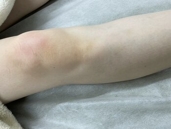 ナノハナ/鹿沼市の全身脱毛美容室ナノハナ