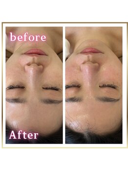 ピュアスキンサロン 恵比寿店(pure skin salon)/自社開発W水光ピーリング