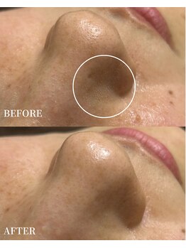 エース(ACE.)/毛穴洗浄で毛穴汚れ徹底除去!