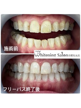 ホワイトニングサロン 京都烏丸店/ホワイトニング施術例