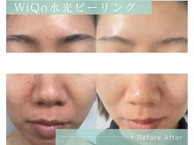 リノア 柏(Lino'a)/WiQo水光ピーリング 1→3回施術