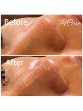 フォーケア(4Care)/ハイドロスキン