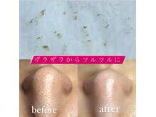 ビューティーネイル(Beauty Nail)/毛穴エクストラクション