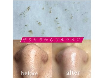 ビューティーネイル(Beauty Nail)/毛穴エクストラクション