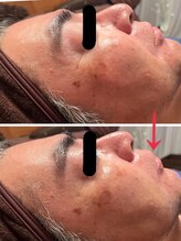 悠羽(yuuwa)/ヒト幹細胞美容液導入1回目