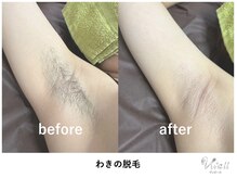 ヴィ オール(Vi.all)の雰囲気（脇脱毛のビフォアフ◎【脱毛 大宮】）