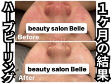 ベル 心斎橋店(Belle)/ハーブピーリング
