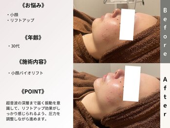 ルディラ 池袋店/小顔バイオリフト