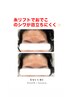 切らない糸リフト！おでこのシワも首のシワもしっかりケア！