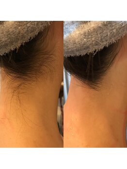 エトル(etole)/20代お客様症例写真