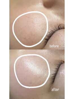 ミュウ(Miu.)/ハーブピーリングbefore/after