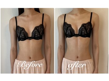 美バストアルファ(美bust α)/【バストアップ】症例