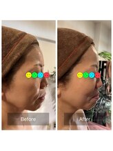 アムスパ(Aum Spa)/ヒト幹細胞上清液導入グロッティ