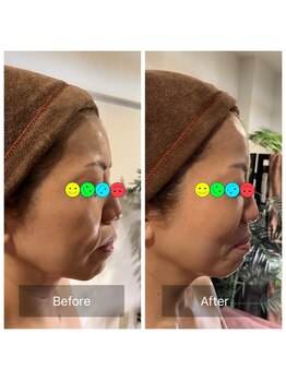 アムスパ(Aum Spa)/ヒト幹細胞上清液導入グロッティ