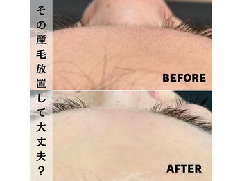 ベレア(BELEA)/産毛除去で変わります！