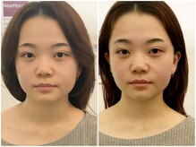 ア ニュームーン 明石ビブレ店(a New Moon)/小顔矯正ビフォーアフター