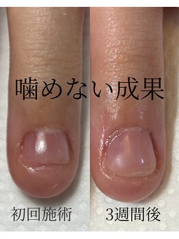 ハンド ケイ(Hand K)/自爪育成