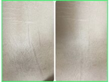 クリア 尾張旭店(Clear)/【Clear脱毛ビフォーアフター】