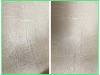 クリア 尾張旭店(Clear)/【Clear脱毛ビフォーアフター】