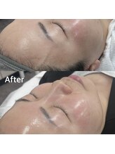 ランティル(l’until)/【毛穴の開きもキュッと閉まる】