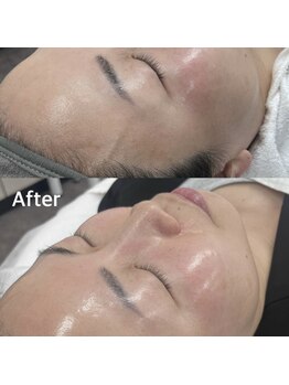 ランティル(l’until)/【毛穴の開きもキュッと閉まる】