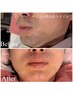 【メンズ脱毛】　お顔脱毛2回体験　