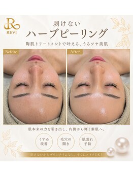 アンフィア(Anfia)/剥けないハーブピーリング