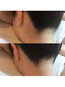 エトル(etole)/20代お客様症例写真