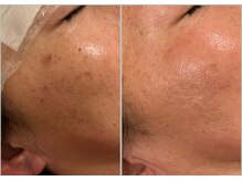 ナンバーナイン(No.9)/IPLシミケア