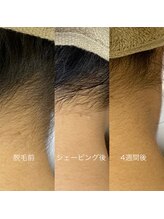 フェリーチェネイル(felice Nail)/うなじ脱毛