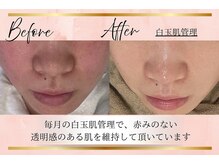 リーズリアン(Rises Lien)/【BeforeAfter】20代 施術１２回