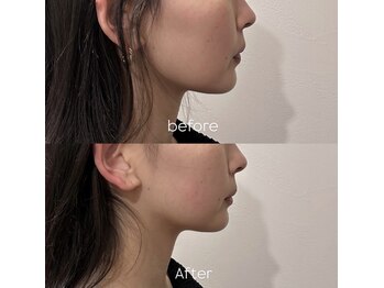 エウレカトーキョー(eureka.TOKYO)の写真/【根本小顔ケア】国家資格者による微細針と小顔矯正を合わせた本格的小顔施術!針が初めての方も大歓迎♪