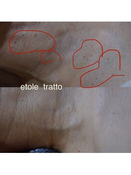 エトル(etole)/50代お客様症例写真