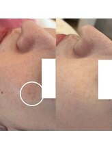 アンク(Ankh)/薄い箇所にもシミケアで改善！