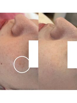 アンク(Ankh)/薄い箇所にもシミケアで改善！