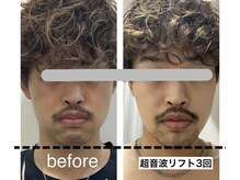 エンチャント(ENCHANT)/メンズ　小顔造形　施術例