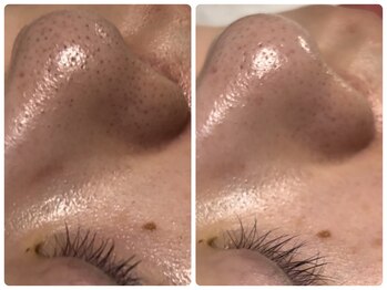 ベルドア(Bell Door)/黒ずみ毛穴