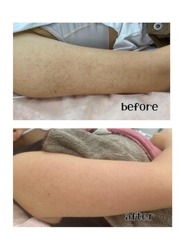 リリベル(LilyBell)/Before After